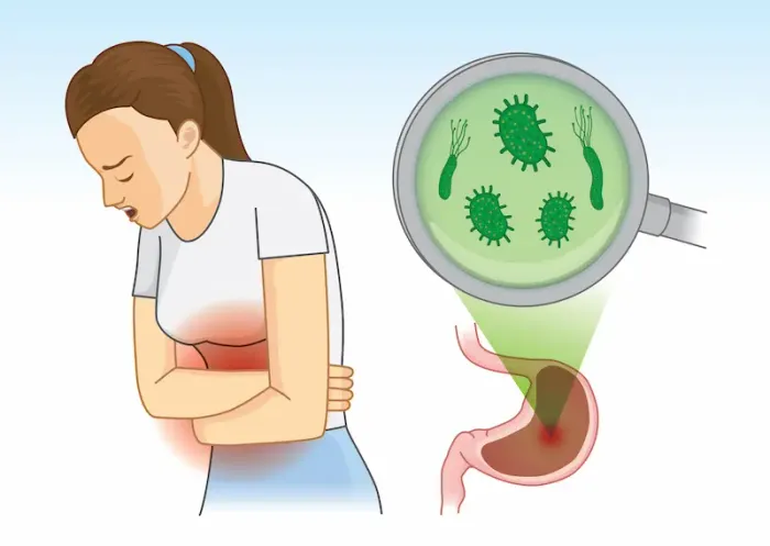 H. Pylori Overview of Symptoms and Treatment
